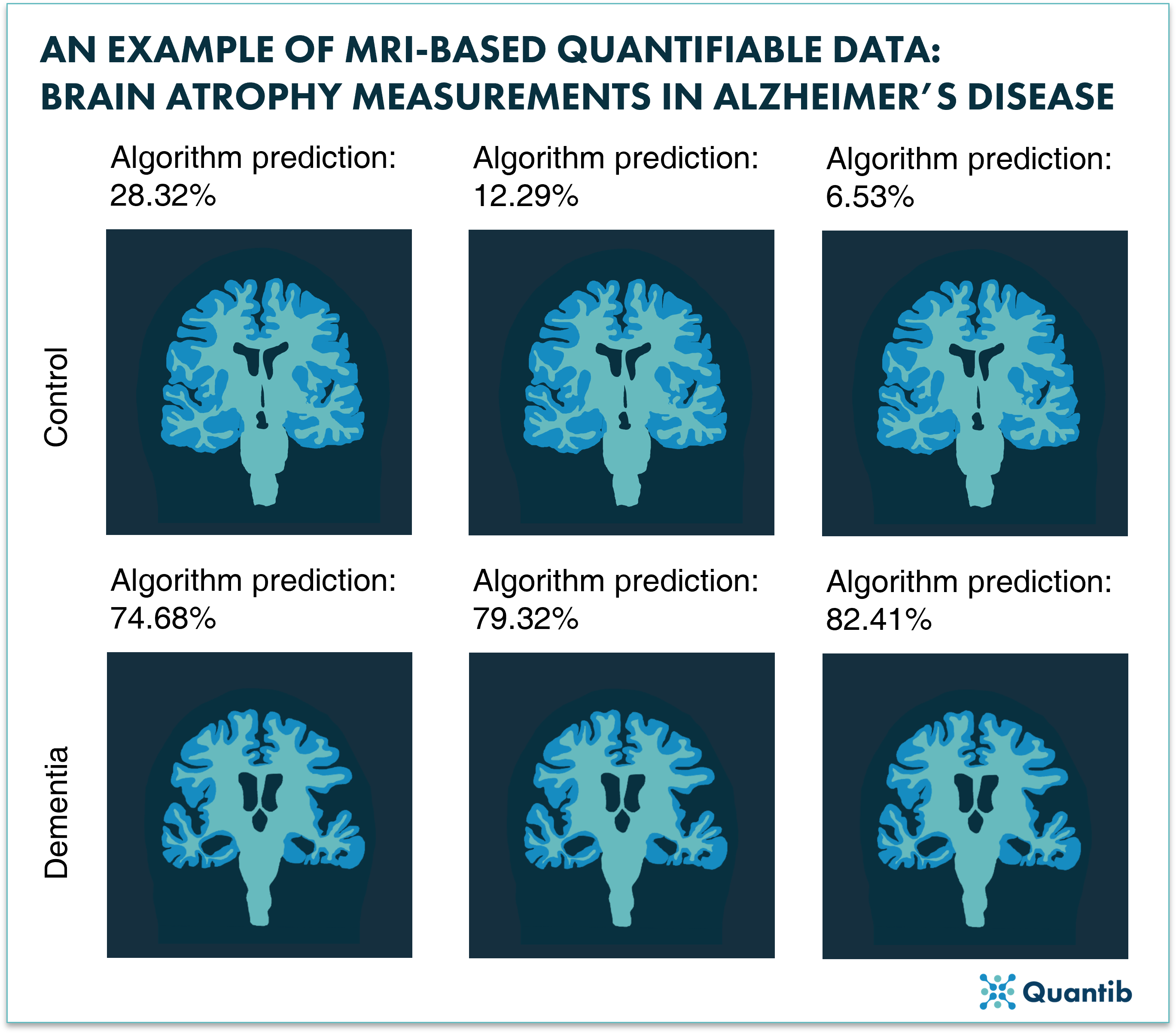 Brain atrophy measurements in Alzheimer's disease