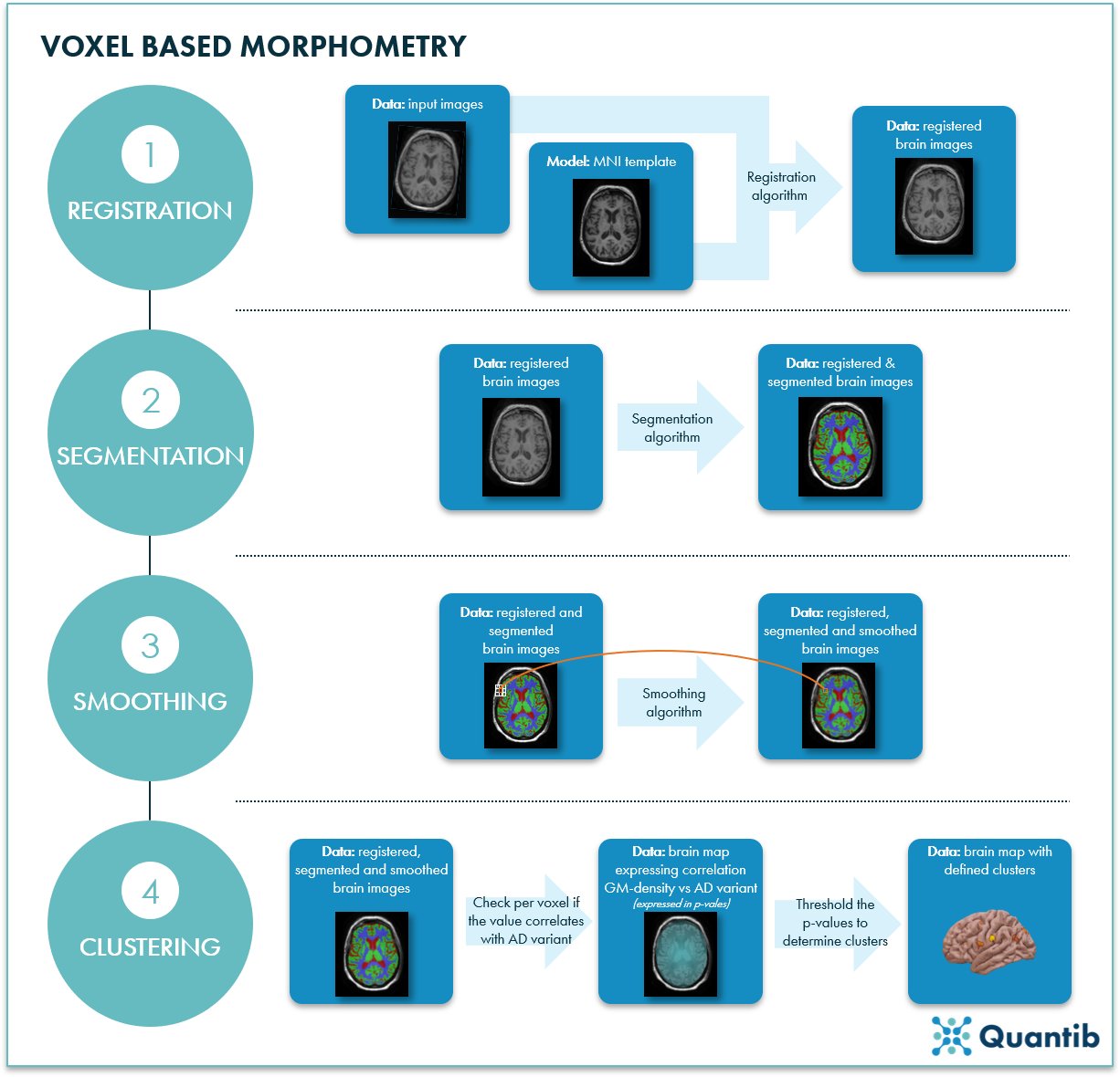 Schematic overview of how to apply voxel based morphometry to MRI brain scans