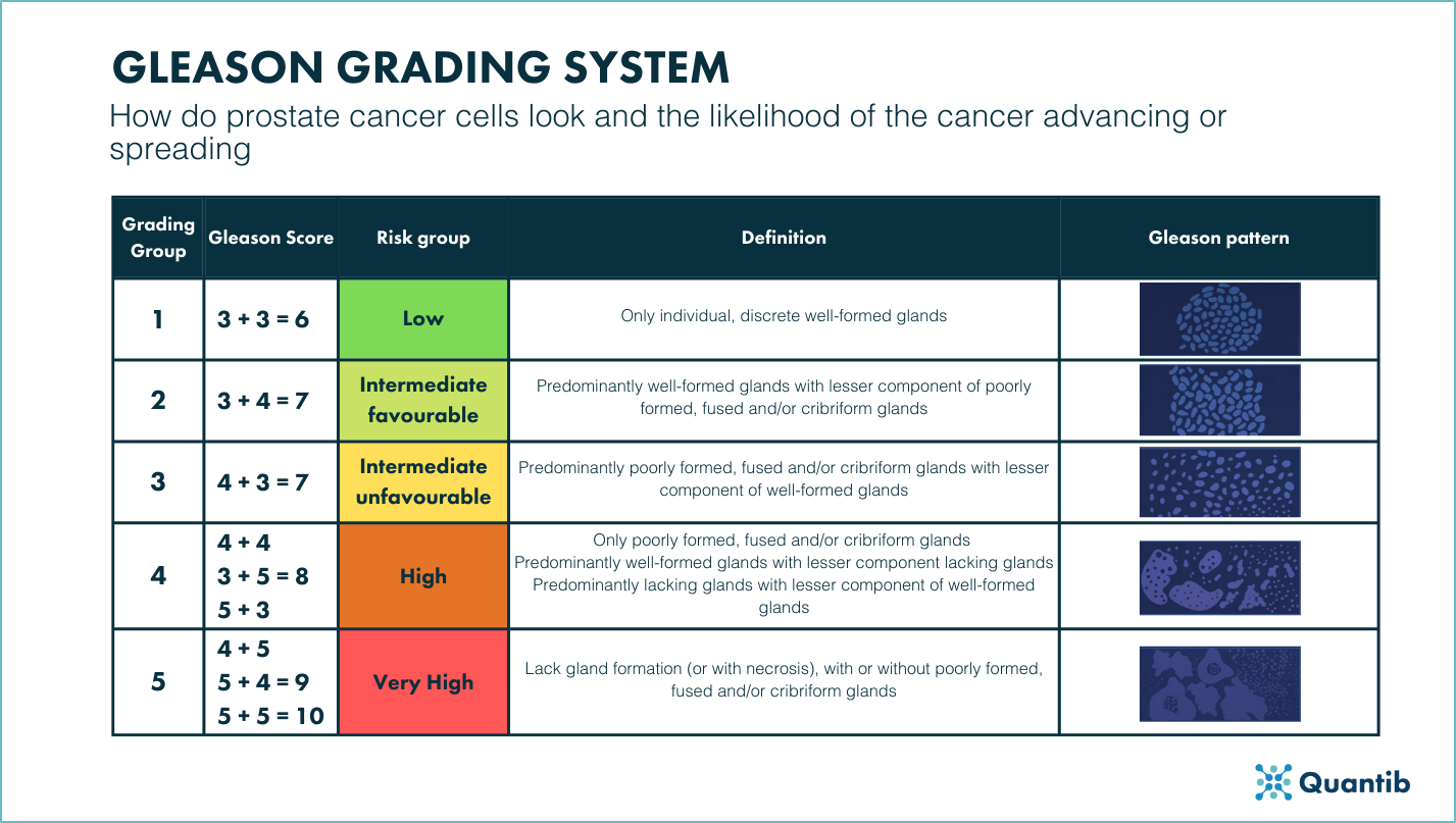 Gleason Grading system and Gleason scores