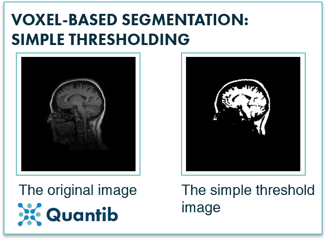 two medical images showing an example of thresholding-based medical image segmentation