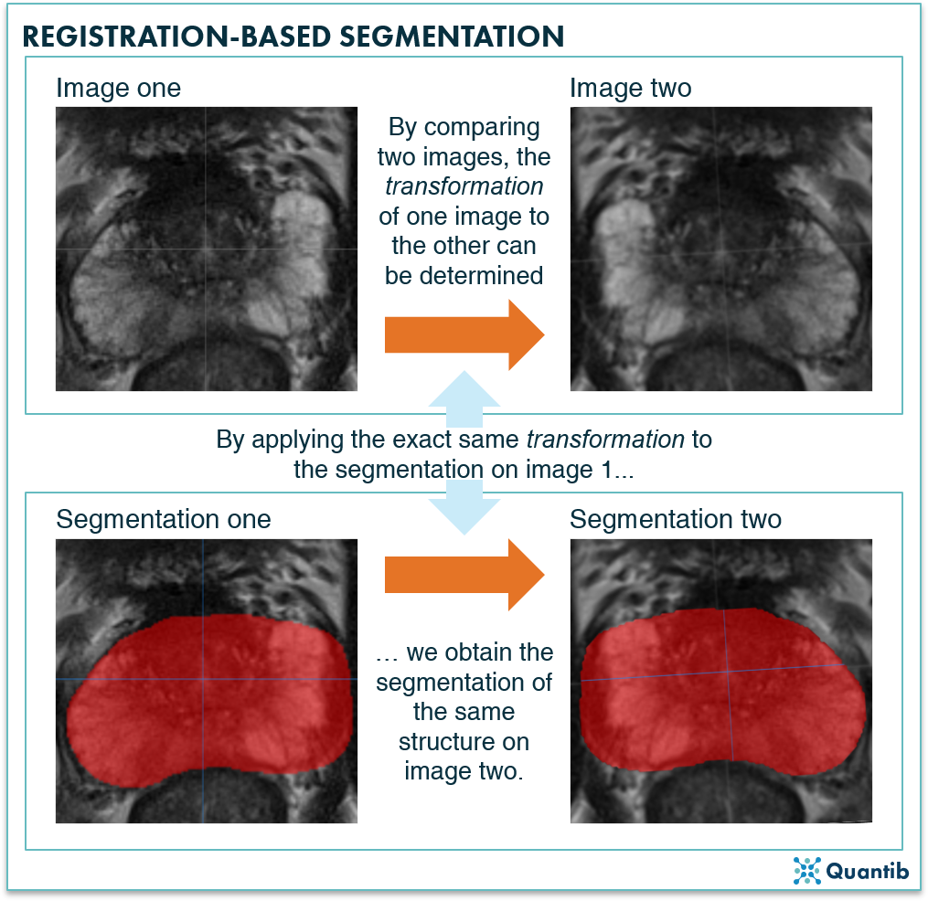 prostate MRI-based example of medical image segmentation based on registration