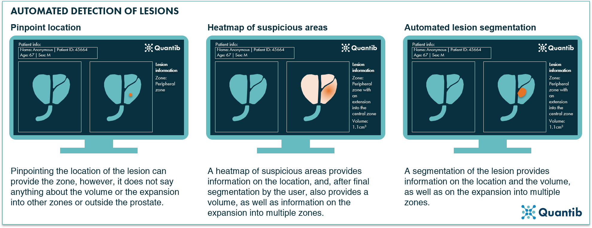 3 options for AI to detect lesions on prostate MRI