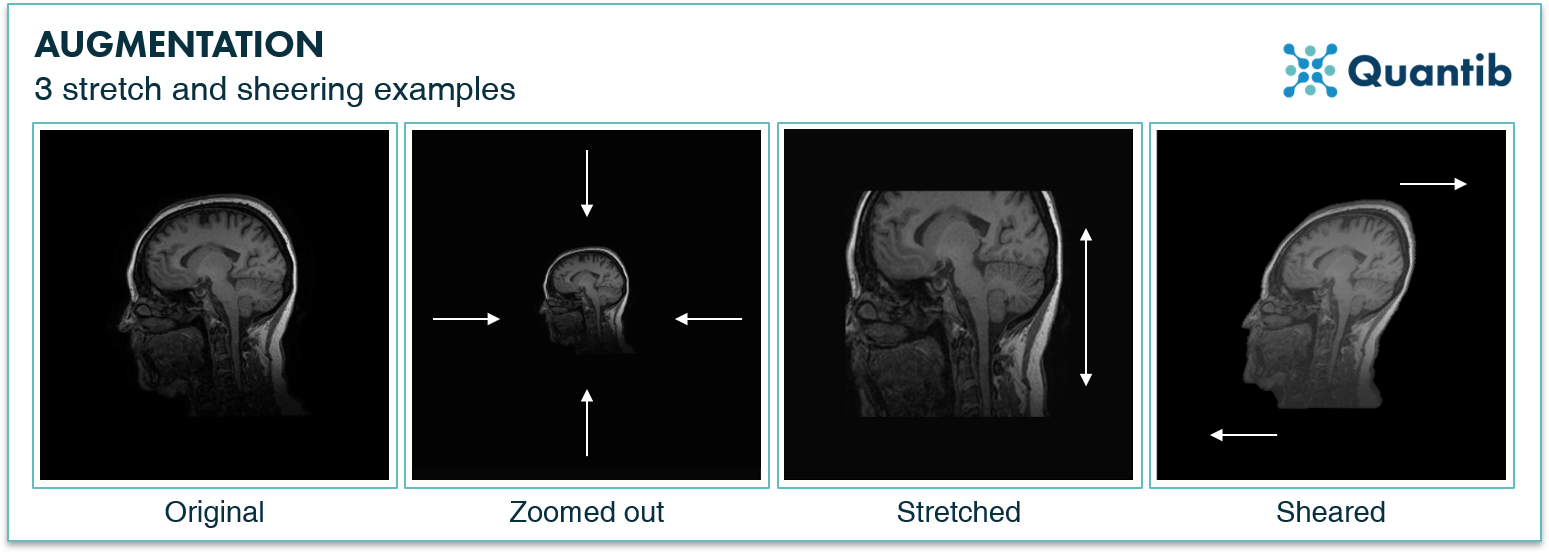 examples of stretching and sheering image augmentation illustrated with medical images