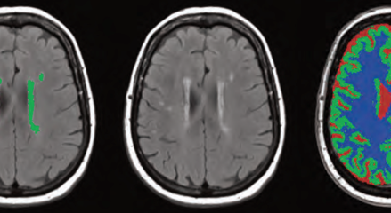 Quantib Brain
